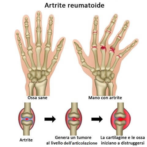Artrite1
